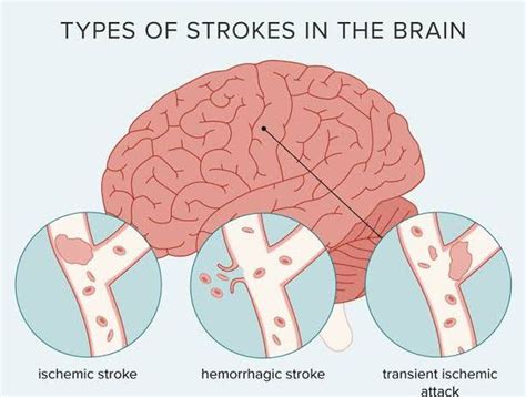 stroke traduzione|stroke meaning in italian.